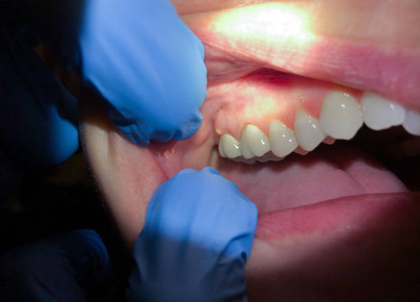 Best Emergency Gum Treatment in Broadway, VA
